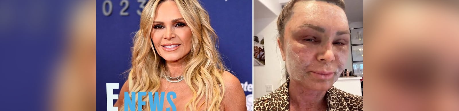 ‘Real Housewives’ Tamra Judge Looks Unrecognizable Following Cosmetic Surgery | E! News