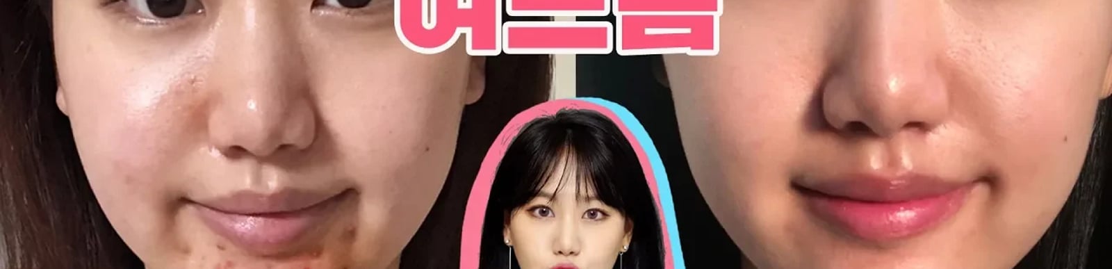 화농성&염증성 여드름 없애는 방법 및 성인여드름관리방법 (feat. 시술 저리가라 / 오롯이 나의 경험담)