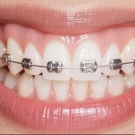 【全国比較】日本で一番安い歯列矯正はココだった！
