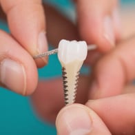 Waarom Tandimplantaten de Beste Keuze zijn voor een Perfecte Lach