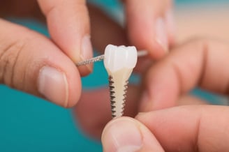 Waarom Tandimplantaten de Beste Keuze zijn voor een Perfecte Lach