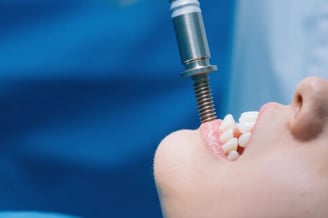 Hoe Tandheelkundige Implantaten je Mondgezonheid Verbeteren