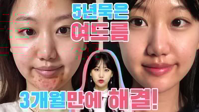 화농성&염증성 여드름 없애는 방법 및 성인여드름관리방법 (feat. 시술 저리가라 / 오롯이 나의 경험담)