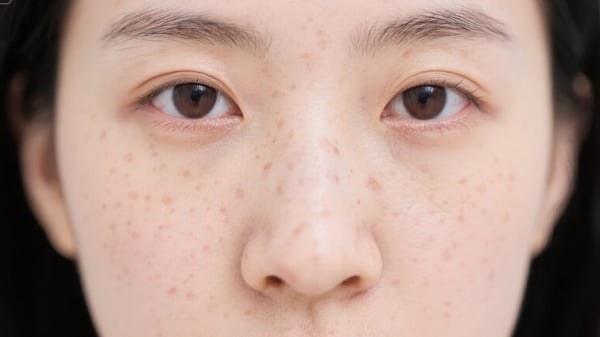 2025美白保養趨勢最重視「淡斑」!皮膚科醫師提醒做好這5件事才能有效淡斑