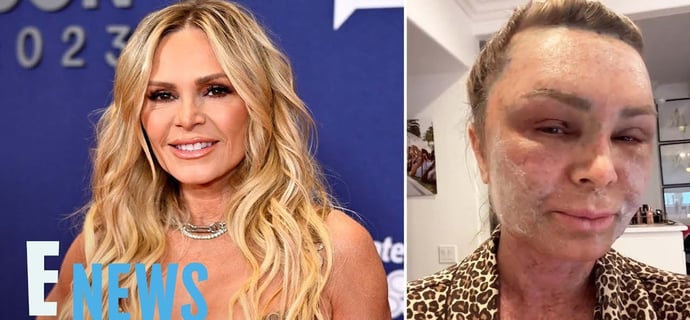 ‘Real Housewives’ Tamra Judge Looks Unrecognizable Following Cosmetic Surgery | E! News