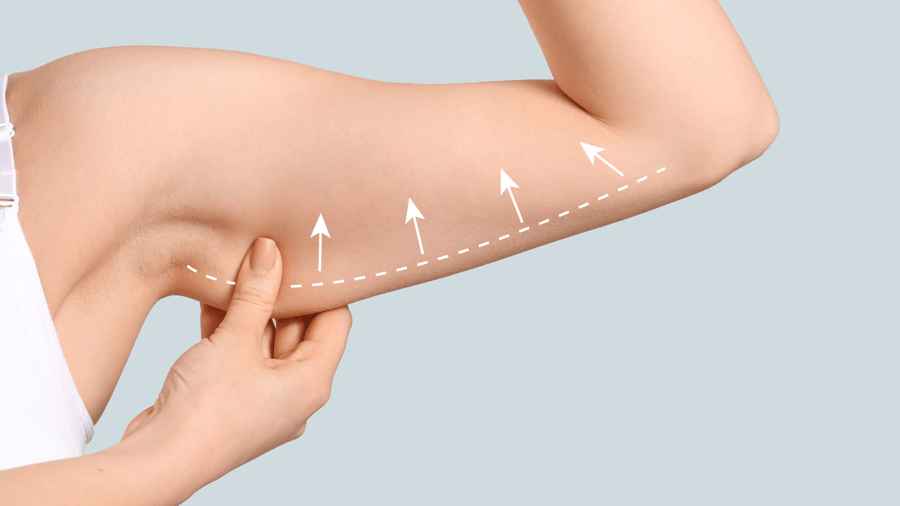 Achieve Youthful Arms: Effective Non-Surgical Arm Lift Solutions for 2025