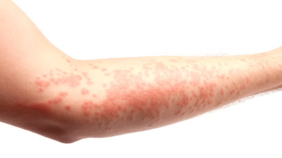 What Psoriasis Looks Like: Symptoms and Appearance